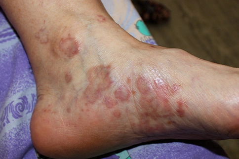 Lichen Planus & Depression