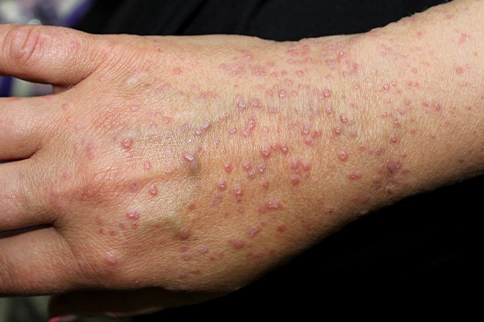Can Lichen Planus be itchy?