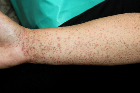 Lichen Planus Treatment in Homeopathy for Effective Solutions