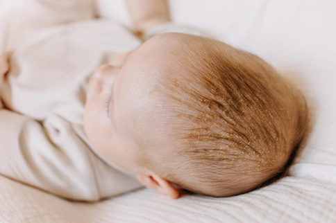My babys head is full of yellowish