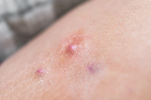 Painful Boils