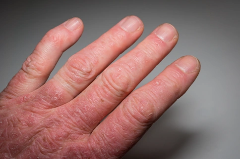 Natural Remedies for Lichen Planus