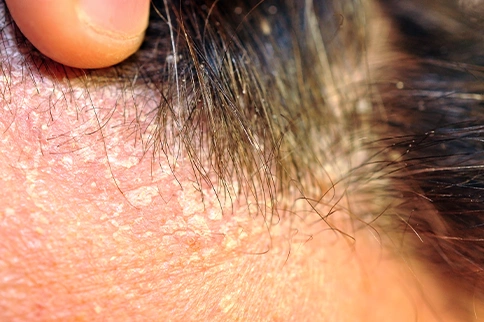 Seborrheic Dermatitis