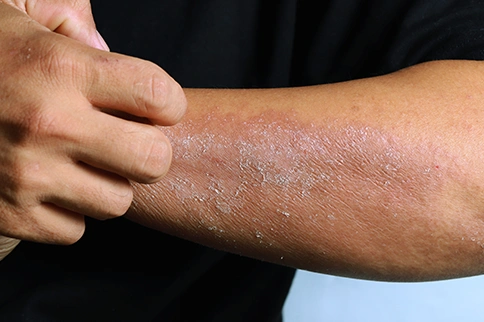 Skin Infections