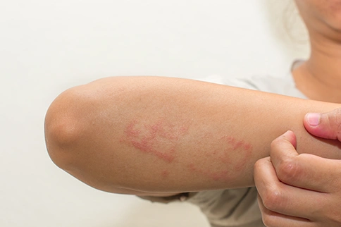 Symptoms of Lichen Planus