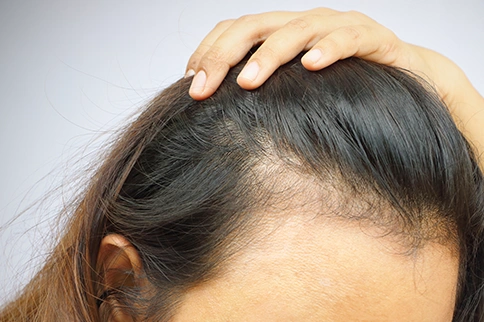 Thin Hair