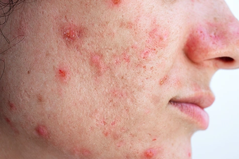Treat Acne Before Scarring