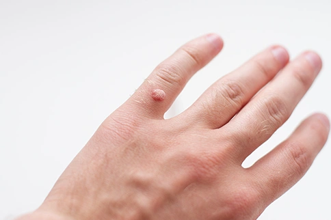 Warts
