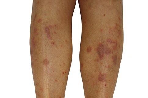 What is the onset of lichen planus?