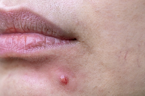 acne scars