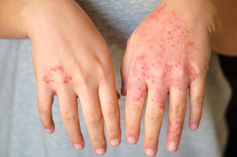Atopic Eczema &amp; Allergic Rhinitis Treatment with Homeopathy