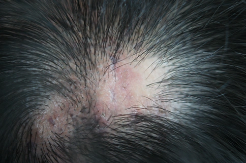 answering questions scalp lichen planus