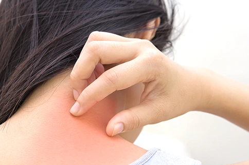 Don’t Let Prickly Heat Ruin Your Summer Fun!
