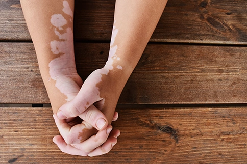 holistic approach for Vitiligo