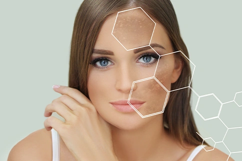 Hyperpigmentation: All You Need to Know