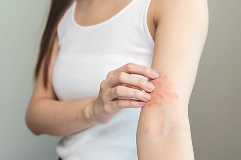 Monsoon &amp; Skin Allergies