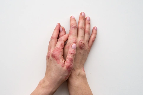 psoriasis