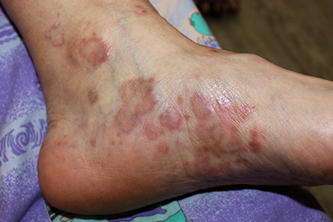 Treat lichen planus