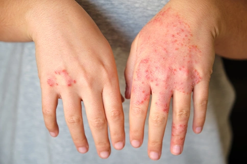 Psoriasis Getting Out of Control