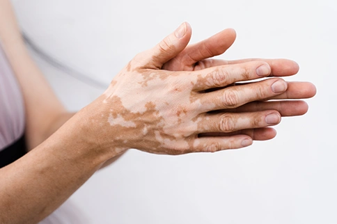 Which Vitiligo Treatment Is Right for You? A Guide by a Skin Doctor