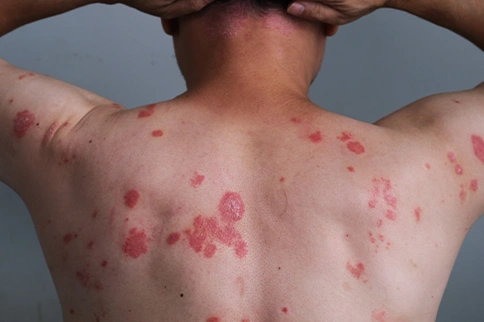 Guttate Psoriasis