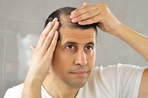 Hairline receding