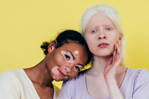 Vitiligo vs Albinism