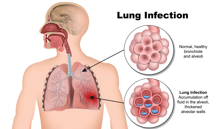 13 Ways to avoid lung infection