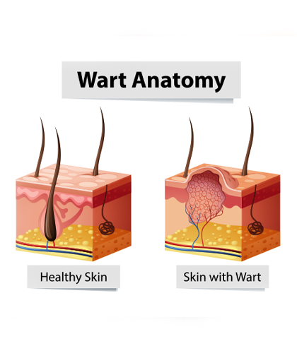 Tips to Manage Warts