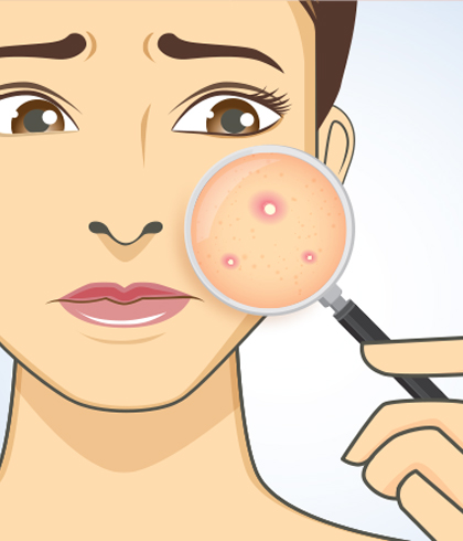 All You Need to Know About Acne