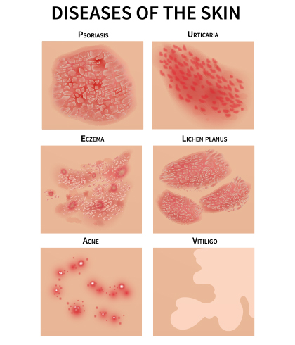 eczema vs psoriasis