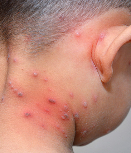 What Causes Skin Infections?