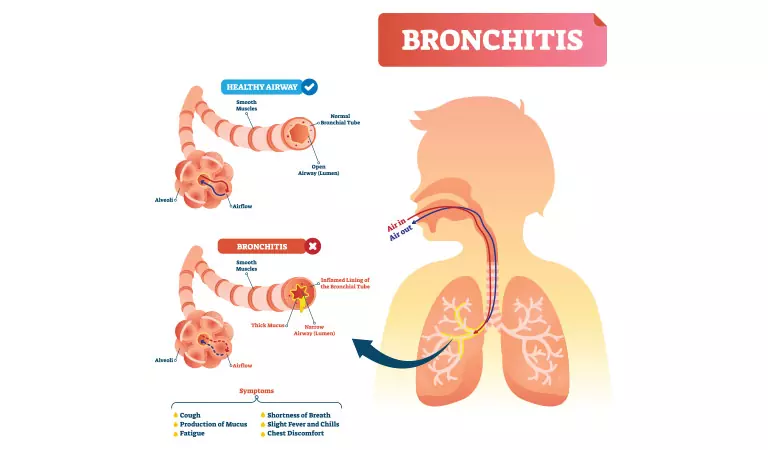 Bronchitis in Children and its Homeopathic Treatment