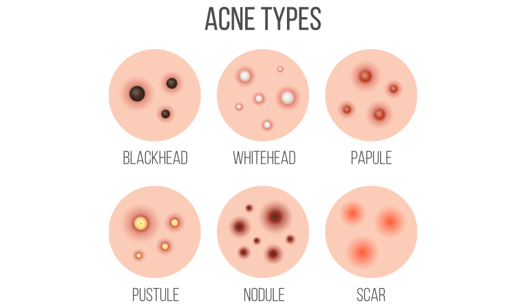 5 things to know before an acne treatment