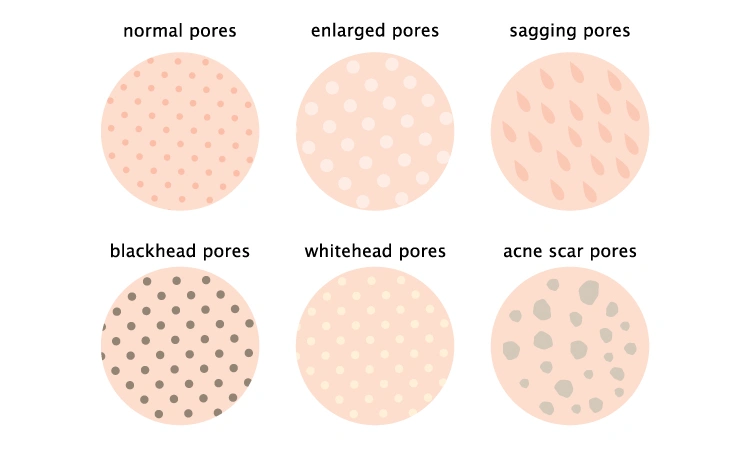 Large Pores vs. Acne Scars