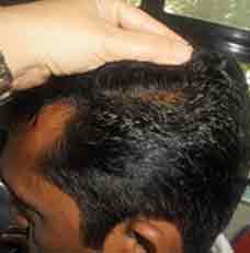 Alopecia-after-outcome