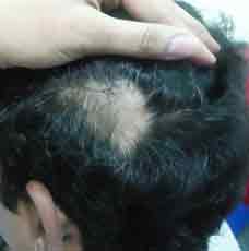 Alopecia-before-outcome