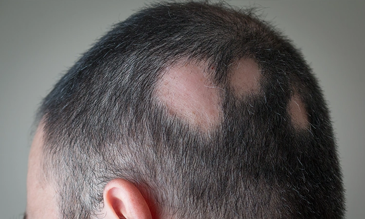 Benefits of Castor Oil for Alopecia Areata