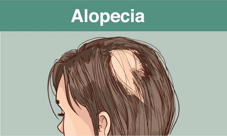 Does Alopecia Areata cause hair thinning?