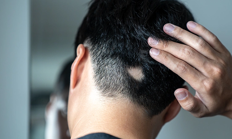 Can stress cause alopecia areata?