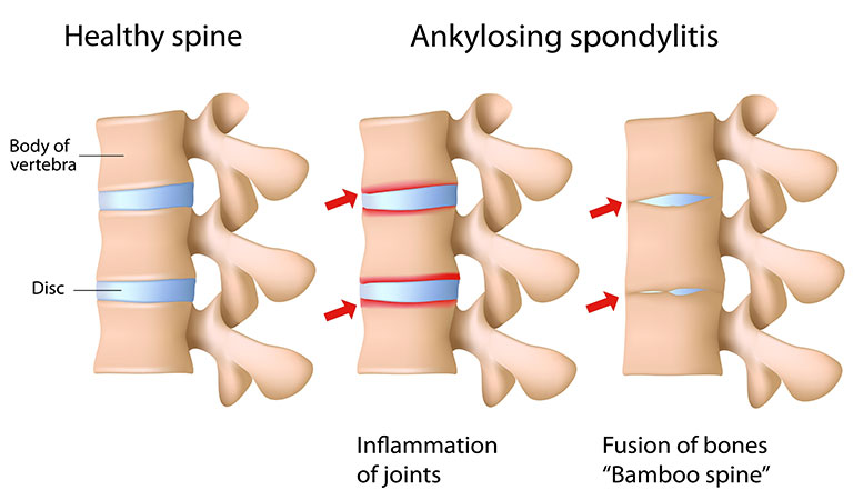 Ankylosing Spondylitis