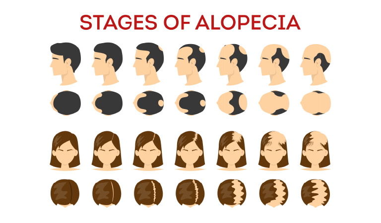 At home alopecia treatments