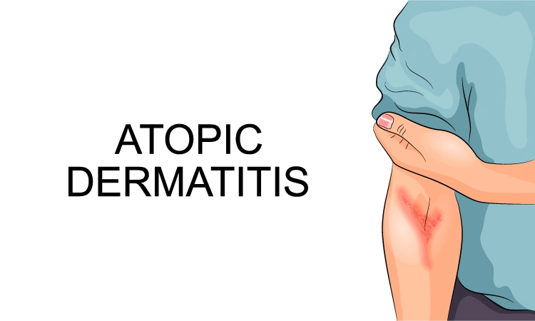 Atopic Eczema and stress