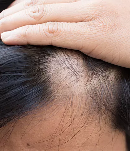 Can stress cause alopecia areata? - Dr Batra's®