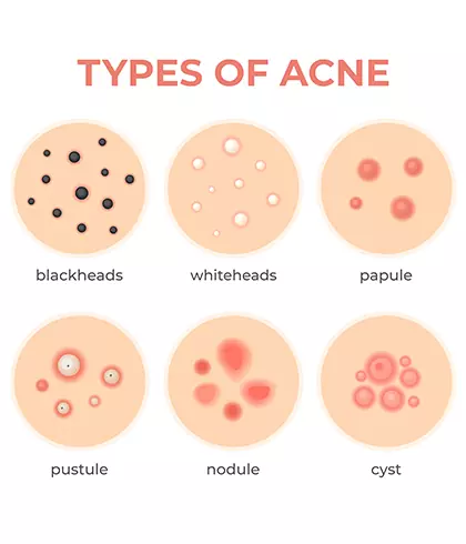 Can Summer And Heat Cause Acne Breakouts? - Dr Batra’s®