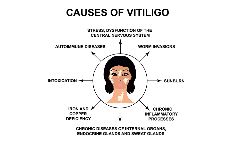 8 things to do following a vitiligo diagnosis