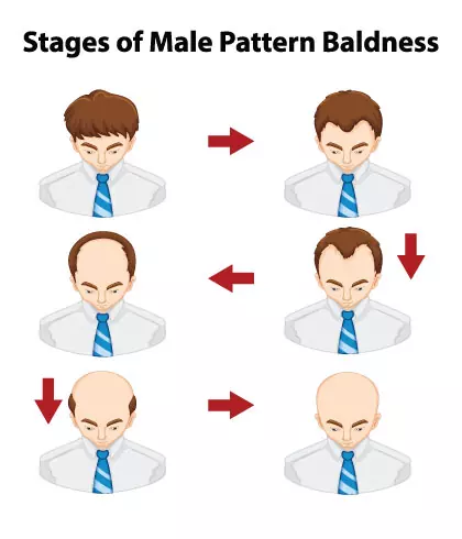10 things you should know about male pattern baldness
