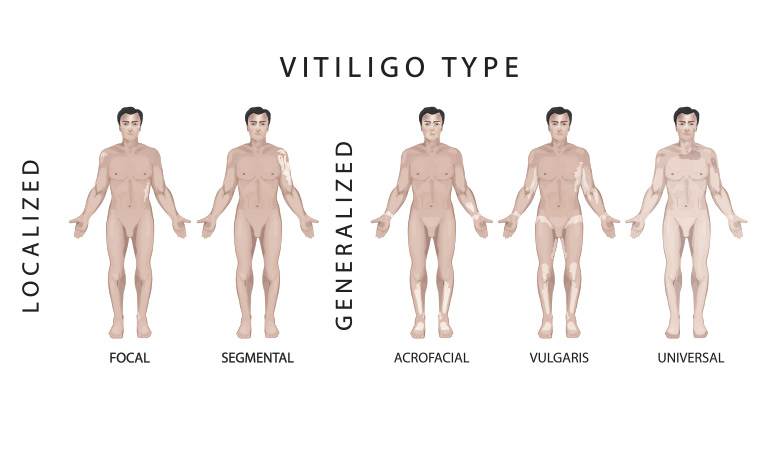 What is the best treatment for vitiligo?