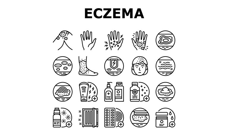 How to know if you have atopic eczema?