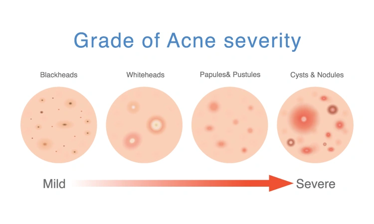 All you need to know about severe acne.